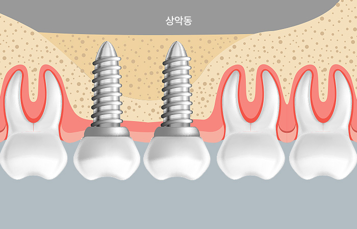 상악동 거상술